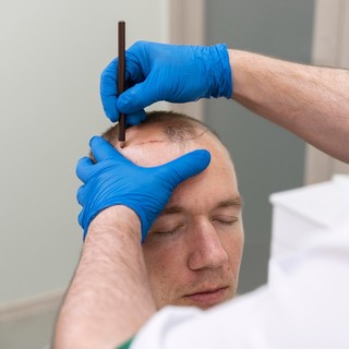 Trapianto di capelli in Italia o Turchia: dove è meglio?