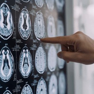 Alzheimer, un antiepilettico potrebbe prevenire le placche: lo studio Alzheimer, un antiepilettico potrebbe prevenire le placche: lo studio