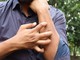Studio Novartis, l’orticaria cronica spontanea costa 4.200 euro l’anno a paziente Studio Novartis, l’orticaria cronica spontanea costa 4.200 euro l’anno a paziente