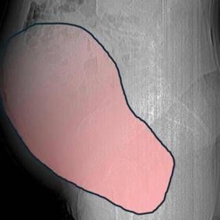 Intervento record al Sant'Anna di Torino, rimosso tumore ovarico di 6 kg