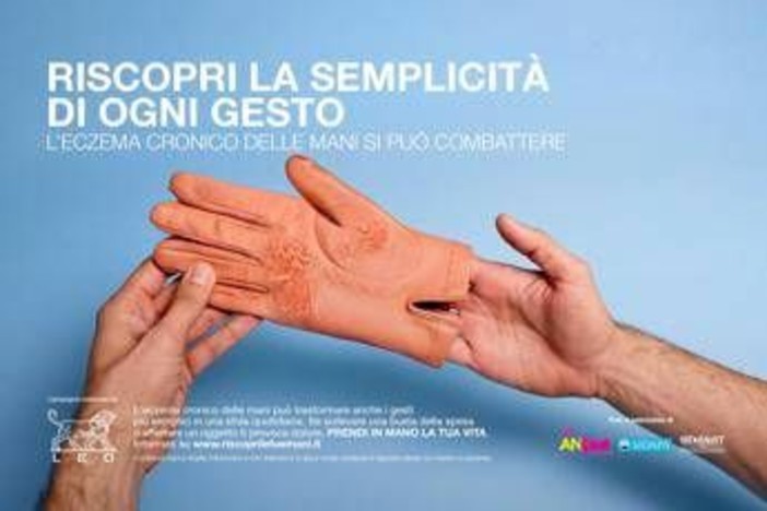 Mani che bruciano e fanno male, al via campagna su eczema cronico