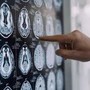 Malattia di Parkinson, ok in Europa a formulazione orale Ld/Cd a rilascio modificato