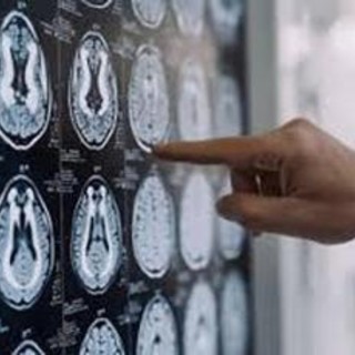 Centro Dbs Pavia, 100 interventi di neurostimolazione profonda per Parkinson