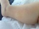 Dermatite atopica, Aifa estende rimborso di upadacitinib dai 12 anni di età Dermatite atopica, Aifa estende rimborso di upadacitinib dai 12 anni di età